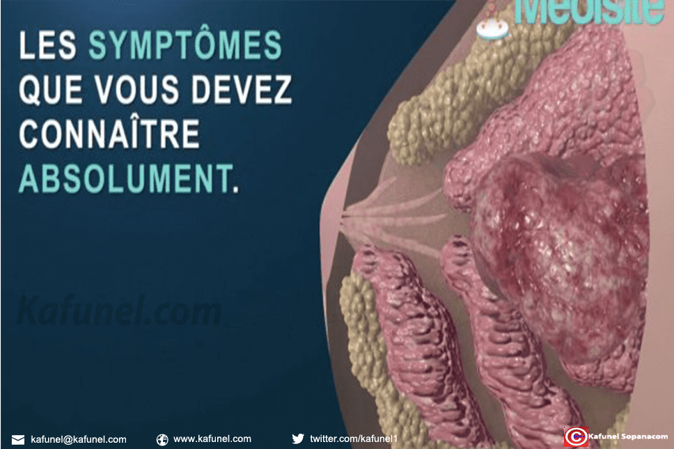 Cancer du sein - quels sont les vrais symptômes.jpg