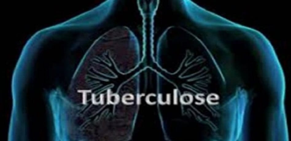 Tuberculose près de 4500 personnes en meurent chaque jour (OMS) Près de 4500 personnes en meurent chaque jour du Tuberculose (OMS)