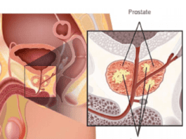cancer de la prostate a la une - Capture