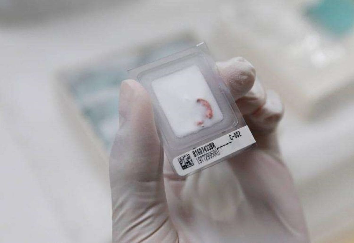 Cancer du pancréas une découverte majeure va permettre de mieux le soigner