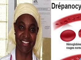 1800-enfants-naissent-chaque-annee-au-senegal-avec-la-drepanocytose-pediatre