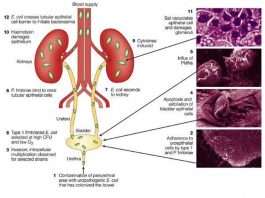 infections des voies urinaires3